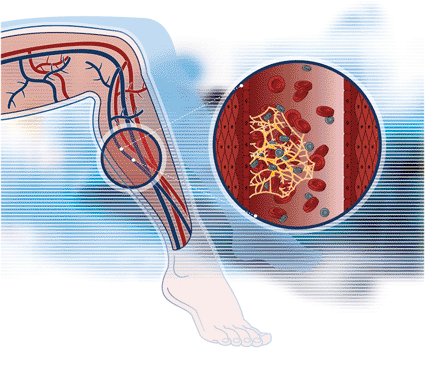 Image: A diagram of the D-Dimer FS immunoturbidimetric test, designed for exclusion of DVT of the leg (Photo courtesy of DiaSys Diagnostic Systems).